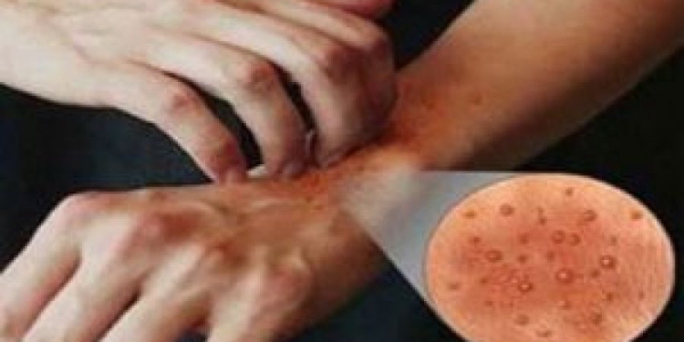 Italia në alarm, zgjebja po përhapet me shpejtësi, rastet u shtuan me 750% në tre vjet