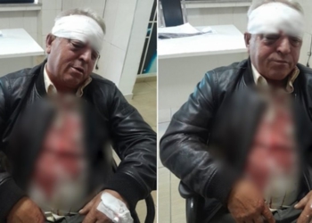 Punonjësi i Ndërmarrjes së Pastrimit dhunohet barbarisht, rrezikon shikimin në syrin e djathtë (Detajet)
