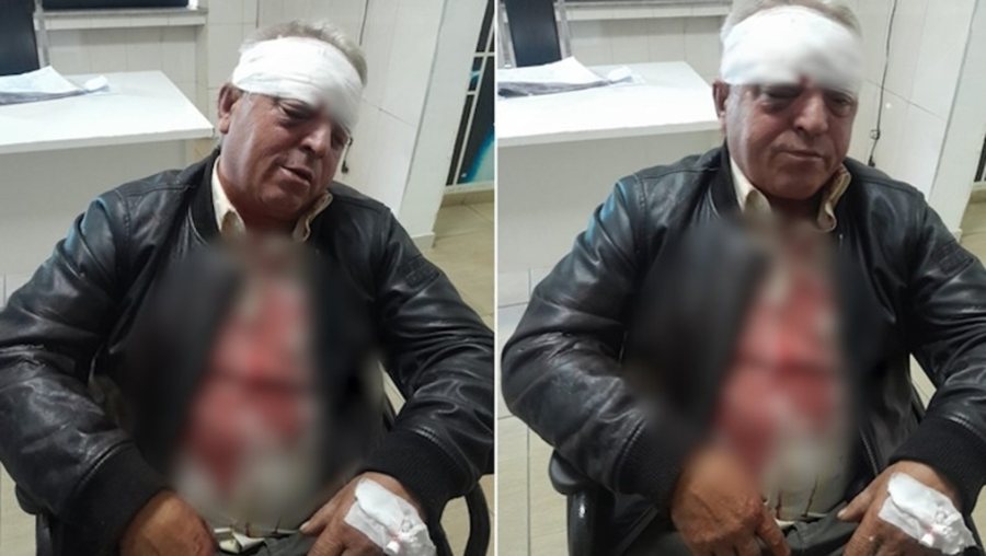 Punonjësi i Ndërmarrjes së Pastrimit dhunohet barbarisht, rrezikon shikimin në syrin e djathtë (Detajet)