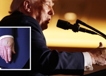 Shfaqet me fasho në duar presidenti Donald Trump, zbulohet arsyeja