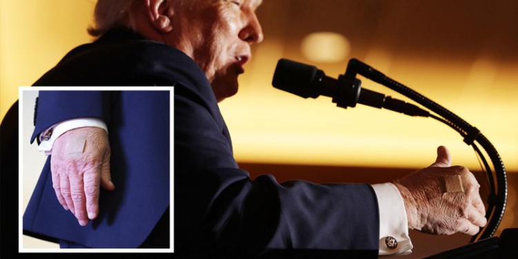 Shfaqet me fasho në duar presidenti Donald Trump, zbulohet arsyeja