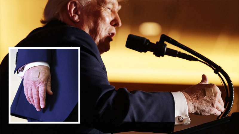 Shfaqet me fasho në duar presidenti Donald Trump, zbulohet arsyeja